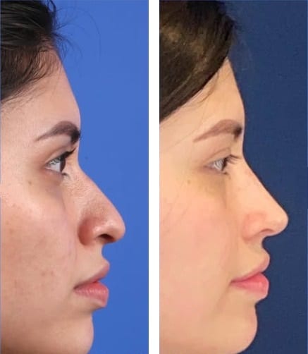 Rinoplastia caso 17 — antes y después